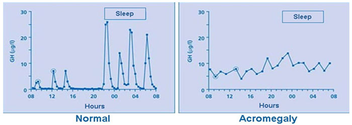 Hypersecretion of Growth Hormone